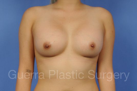 next Case #1001118 After