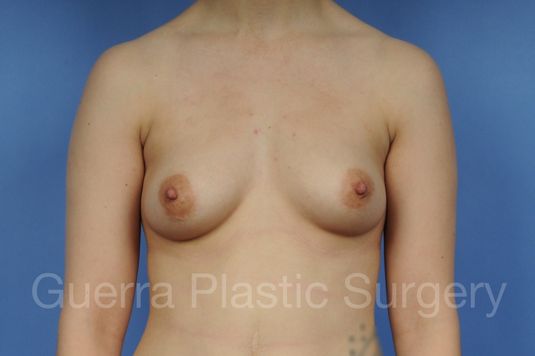 next Case #1001119 Before