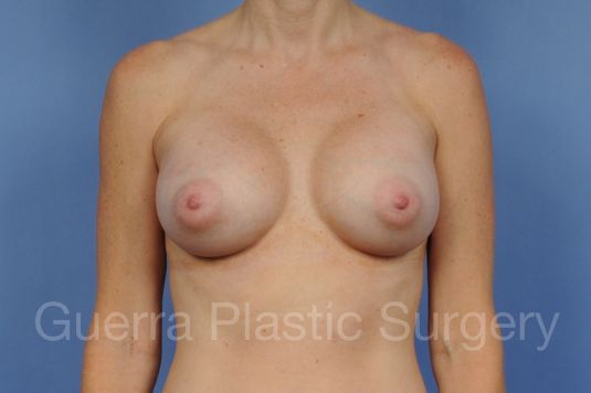 prev Case #1001122 After