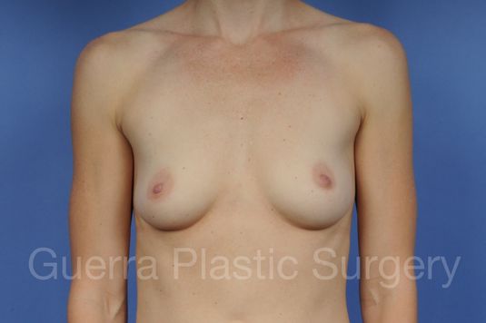 next Case #1001126 Before