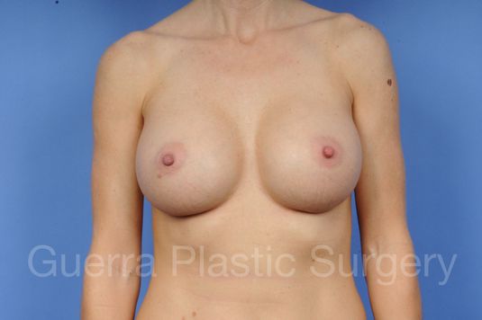 prev Case #1001130 After