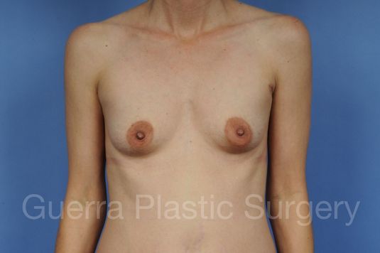 next Case #1001132 Before