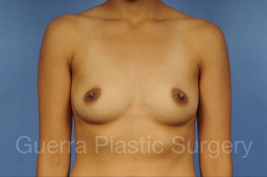 next Case #1001133 Before