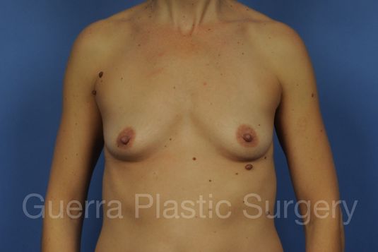 next Case #1001134 Before