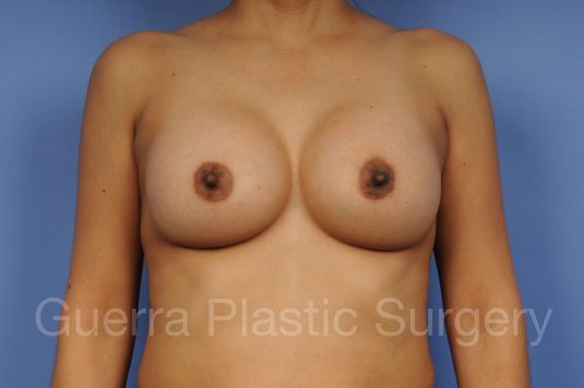 prev Case #1001135 After