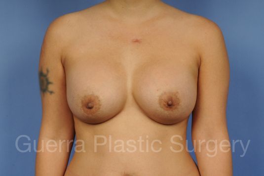 prev Case #1001137 After