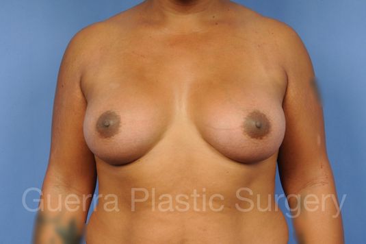 prev Case #1001142 After