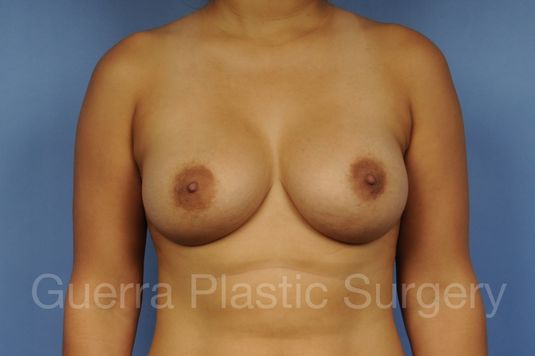 prev Case #1002045 After