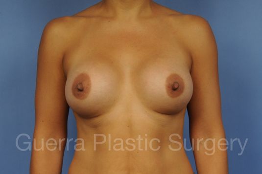 prev Case #1002046 After