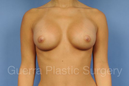 next Case #1001144 After