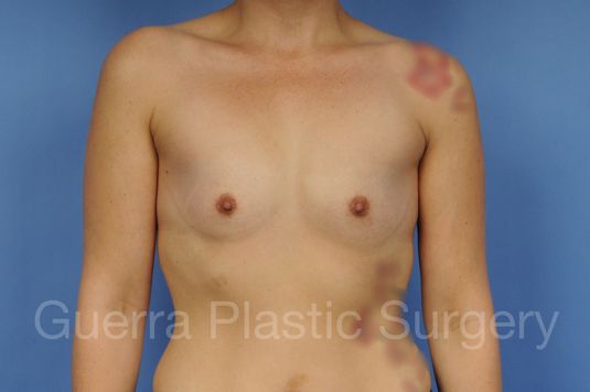 next Case #1001149 Before