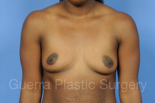 next Case #1001155 Before