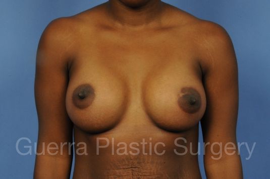 next Case #1001155 After