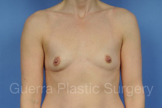 next Case #1001156 Before