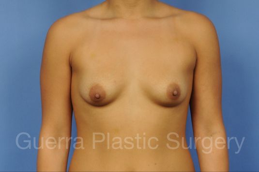 next Case #1001158 Before