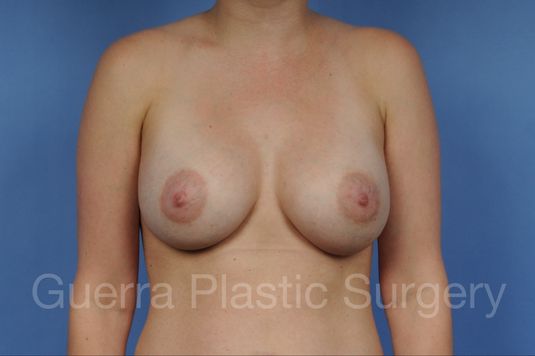 prev Case #1001159 After