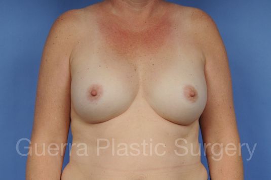 prev Case #1001161 After