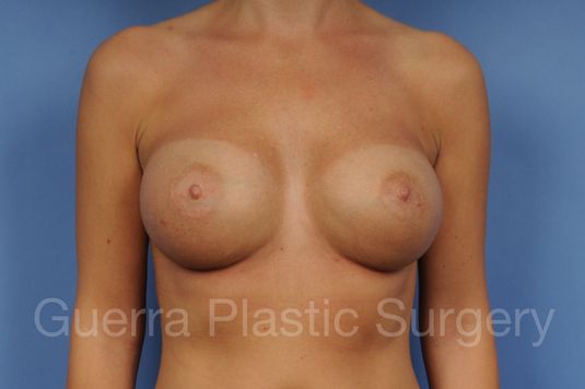 prev Case #1001162 After