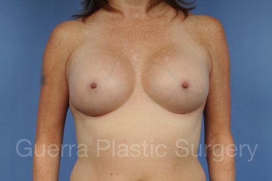 next Case #1001163 After