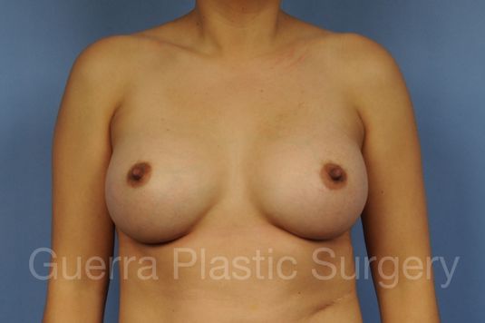 prev Case #1001164 After