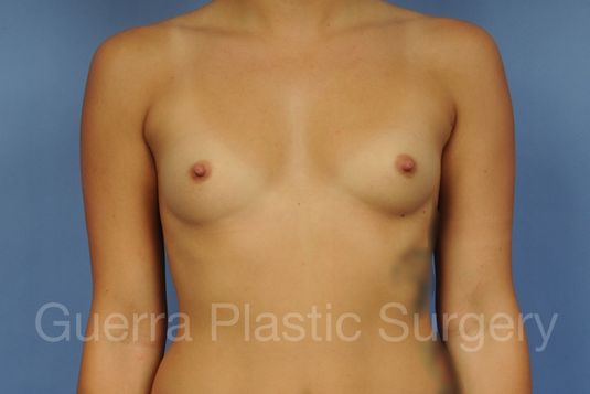 next Case #1001165 Before