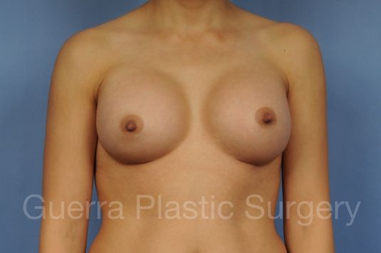 prev Case #1001166 After