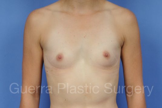 next Case #1001167 Before