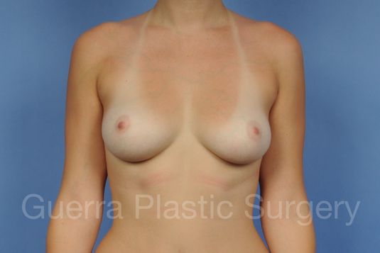 next Case #1001169 Before