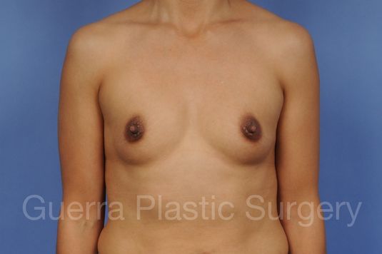 next Case #1001170 Before