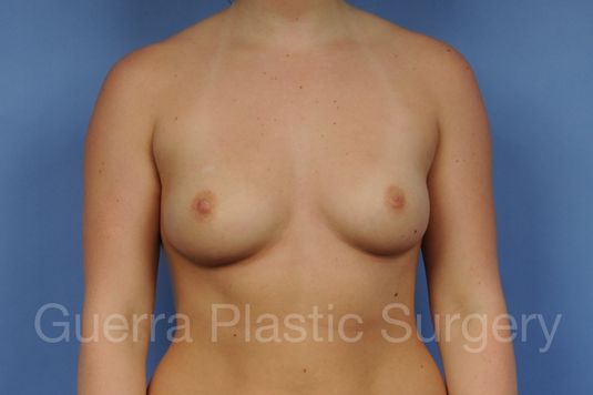 next Case #1001174 Before