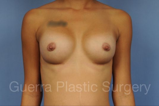 next Case #1002152 After