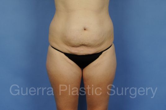 prev Case #01306 Before