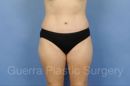 prev Case #01306 After