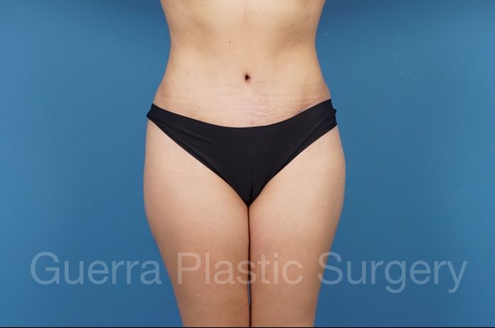 Tummy Tuck Case #34553 - after