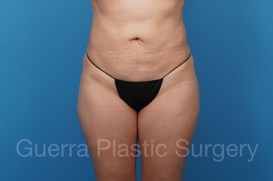 Before Photo Tummy Tuck