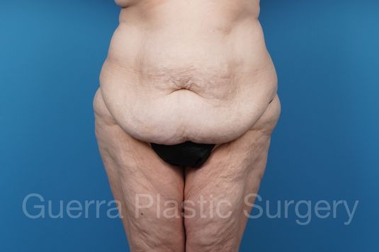 Before Photo Tummy Tuck