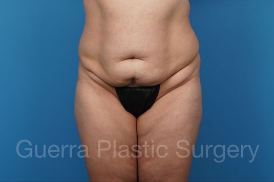 Case #41161_2 Before