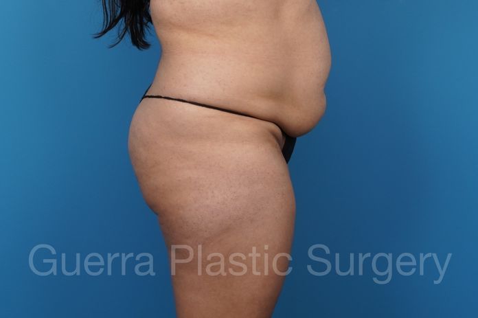Tummy Tuck Case #41161_2 - before