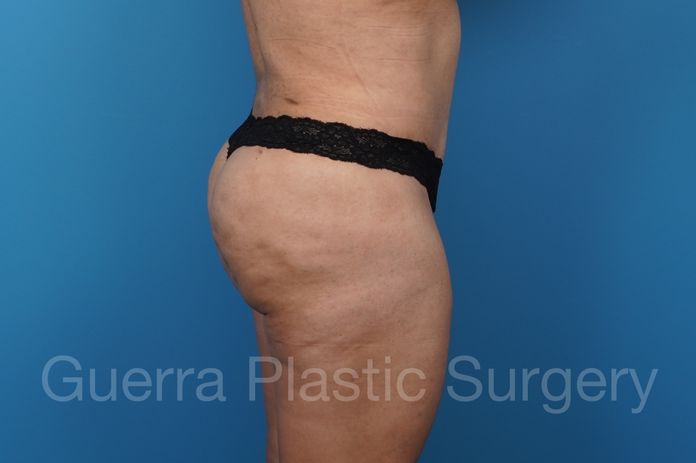Tummy Tuck Case #41161_2 - after
