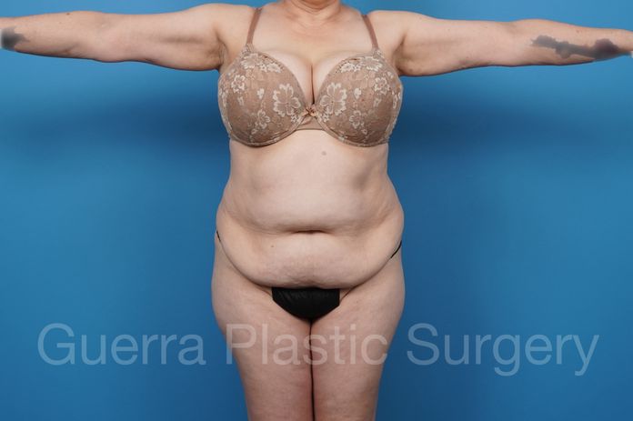 Tummy Tuck Case #40912 - before