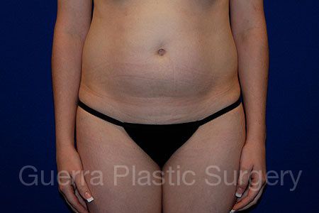 next Case #144889 Before