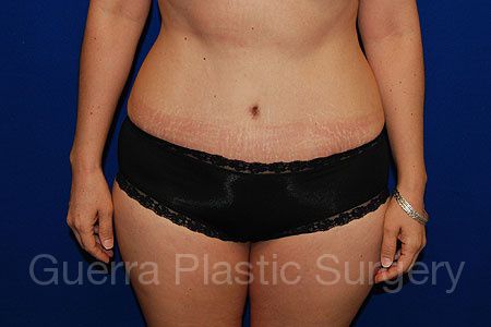 prev Case #25653 After