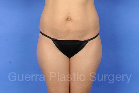 Before Photo Tummy Tuck