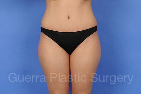 After Photo Tummy Tuck