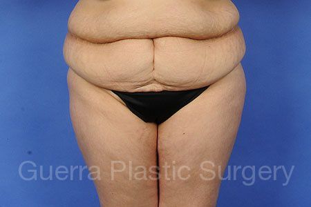 Tummy Tuck Case #52387 - before