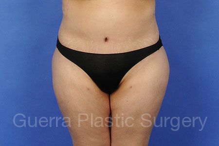 Tummy Tuck Case #52387 - after
