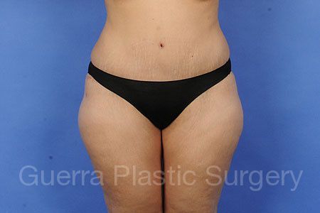 prev Case #97996 After