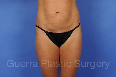 next Case #11154 Before