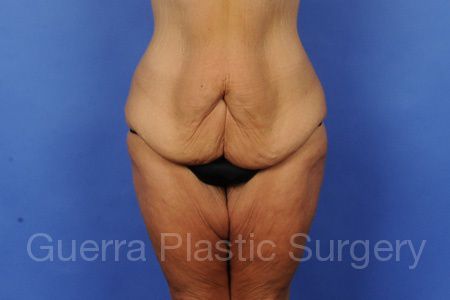 Tummy Tuck Case #28769 - before