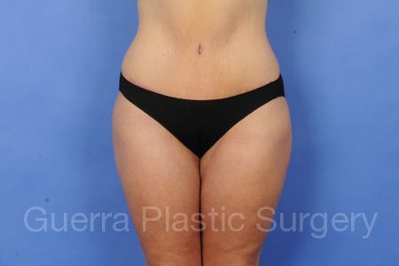 Tummy Tuck Case #28769 - after